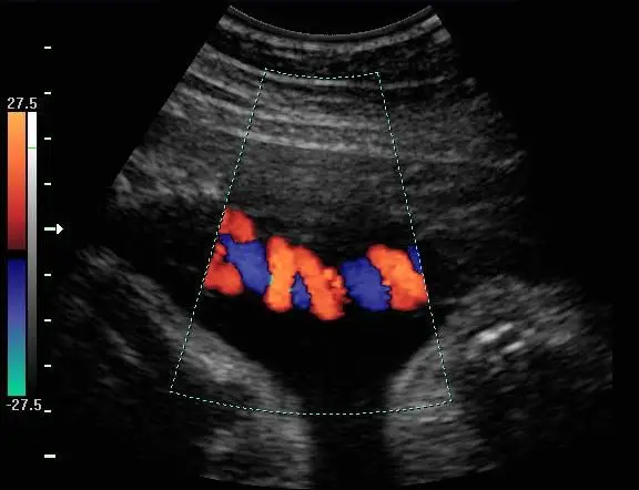 cordão umbilical doppler