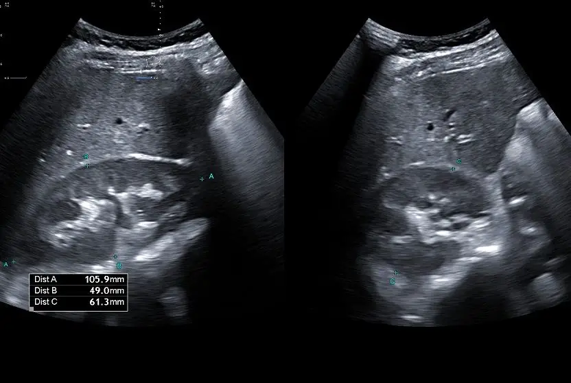 ULTRASSOM DOS RINS E VIAS URINÁRIAS: Desvendando esse exame importante!