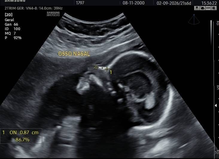 Imagem de ultrassom morfológico de segundo trimestre mostrando perfil fetal